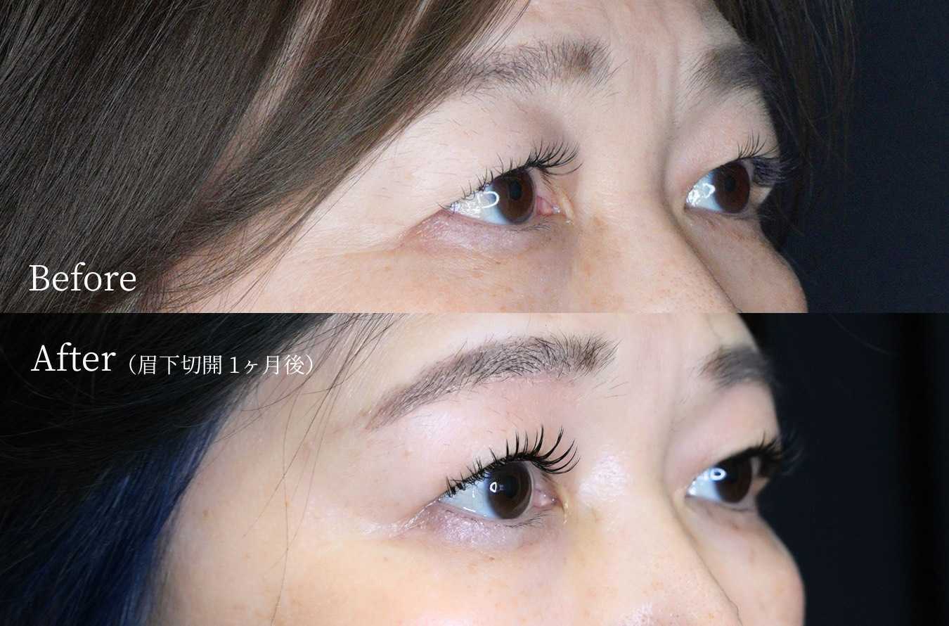 眉下切開の症例写真1：術前（Before）と術後1ヶ月（After）の比較