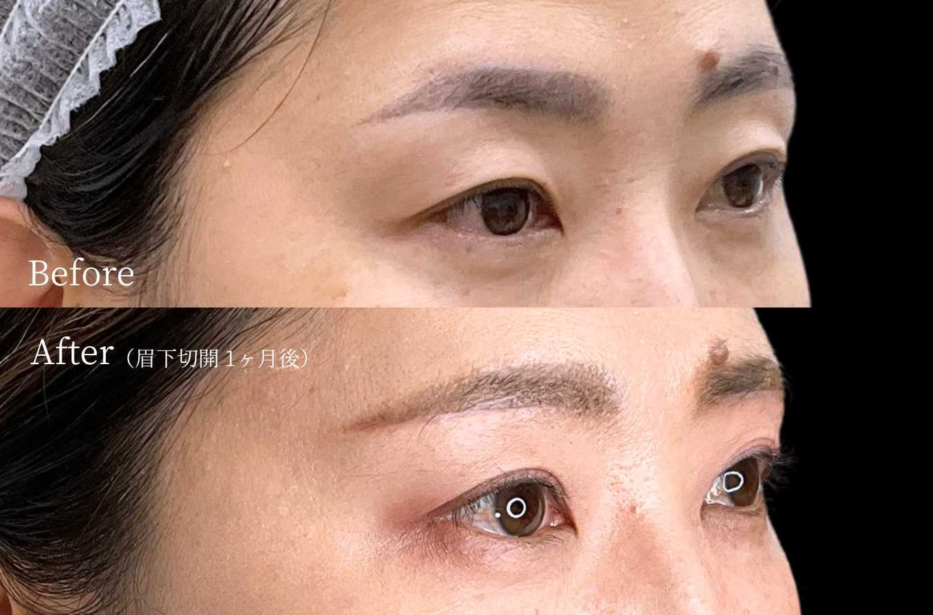 眉下切開の症例写真2：術前（Before）と術後1ヶ月（After）の比較